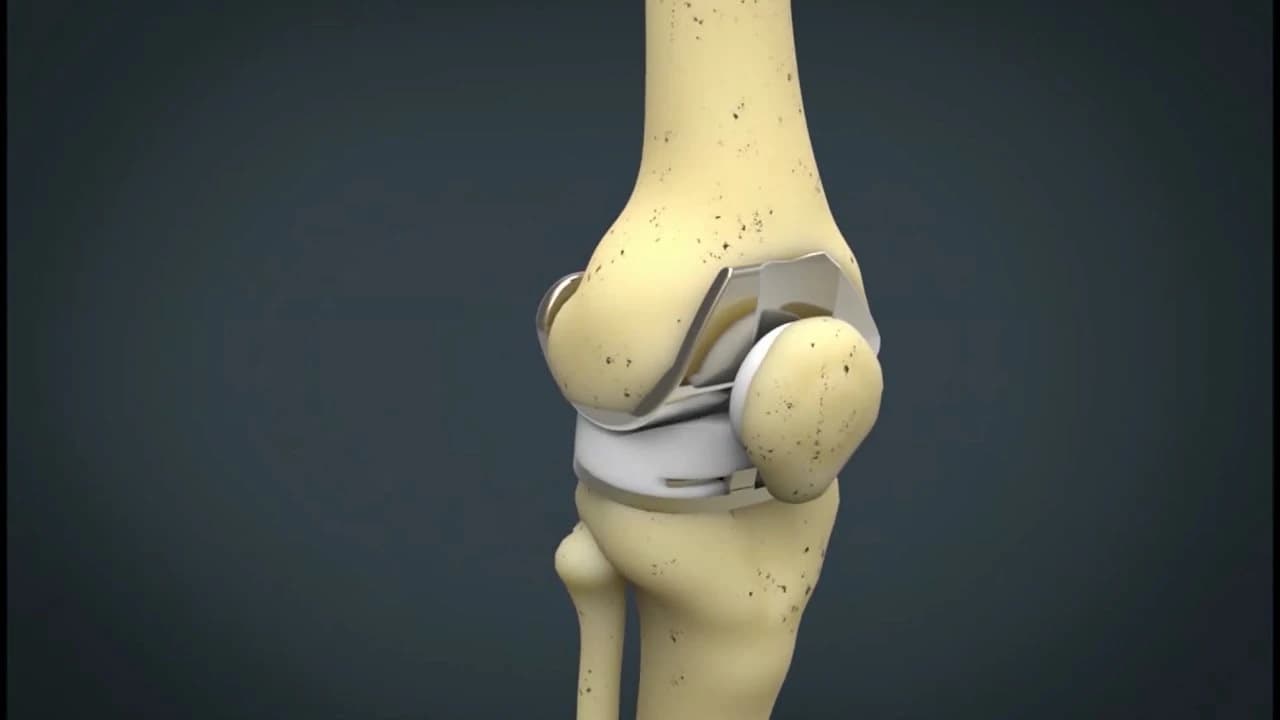 Reemplazo de Articulaciones